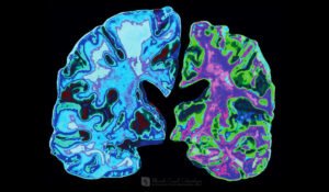 Leia mais sobre o artigo FINALMENTE, PODEMOS SABER O QUE CAUSA A DOENÇA DE ALZHEIMER E COMO PARÁ-LA