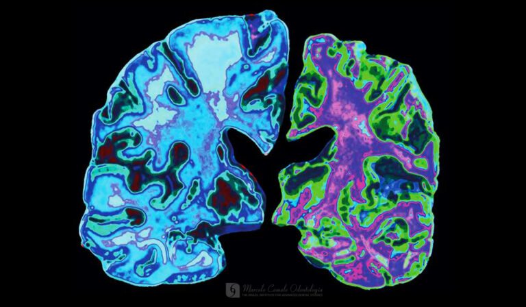 Leia mais sobre o artigo FINALMENTE, PODEMOS SABER O QUE CAUSA A DOENÇA DE ALZHEIMER E COMO PARÁ-LA