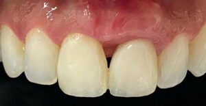 Leia mais sobre o artigo Regeneração de Papilas-III