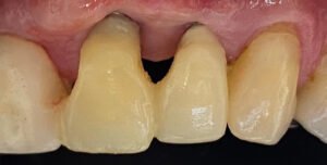 Leia mais sobre o artigo Regeneração de Papilas-I