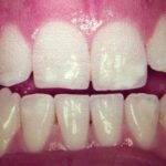 Ajuste Oclusal e Regeneração Periodontal